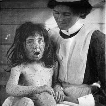 Child with smallpox, 1904